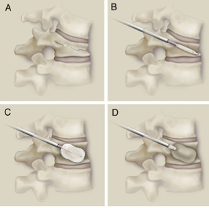 kyphoplasty