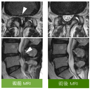 微創內視鏡椎管減壓術後MRI