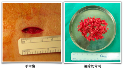 surgical_wound_MEDL
