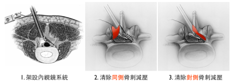 微創內視鏡椎管減壓術