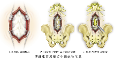 process_laminectomy