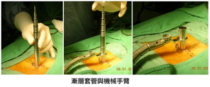 脊椎內視鏡過程