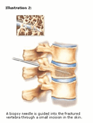 vertebroplasty-2
