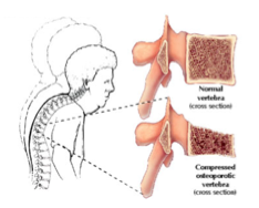 kyphosis_VCF