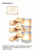 vertebroplasty-4