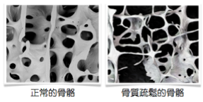 骨質疏鬆