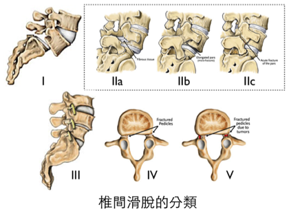This image was adapted from http://www.back.com/causes-mechanical-spondylolisthesis.html