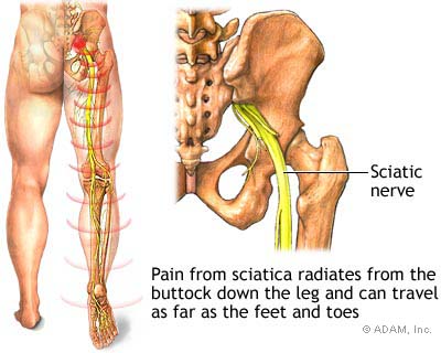 This image was adapted from The New York Times websites http://health.nytimes.com/health/guides/disease/sciatica/overview.html